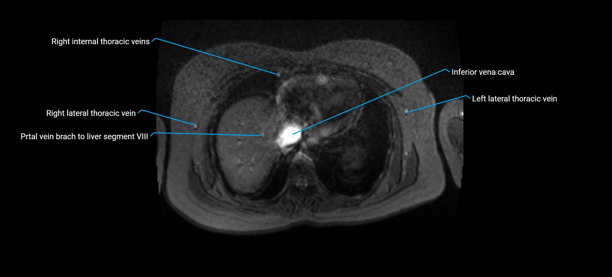 MRV abdomen pelvis & lower limb axial cross sectional anatomy labelled MRI image 14 (1).webp
